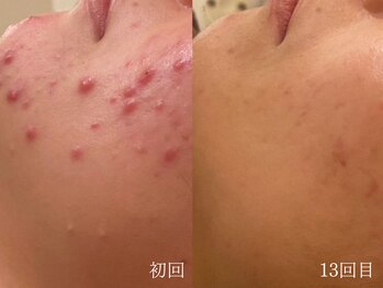 ウォーム(warm)/【肌質改善専門店warm】肌質改善