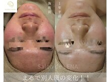 サロンドレナ 名駅店/ハーブピーリング サロンドレナ