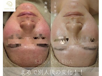 サロンドレナ 名駅店/ハーブピーリング サロンドレナ