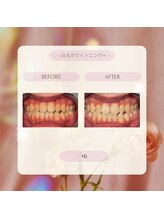 プラスビーセルフ(+b self)/ホワイトニングビフォーアフター
