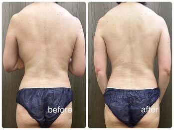 サロン ド ノーブル/【背中】ビフォーアフター