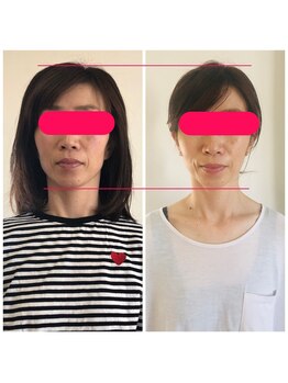 わたしの/小顔矯正