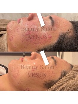 ヴィーナス(Venus)/あらゆる肌悩みへアプローチ