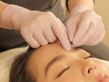 トーリ 代官山(taulli)/前額部への鍼【代官山/鍼灸】