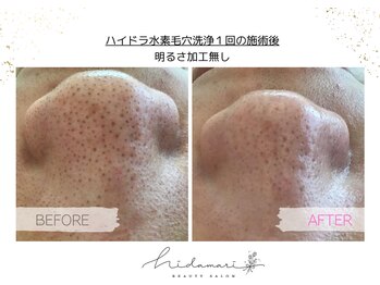 ヒダマリ(Hidamari)/ハイドラ水素毛穴洗浄