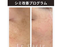 ルカシエ(Le Cacie)の雰囲気（シミ改善ならお任せください！平均4～6ヶ月で驚きの変化）