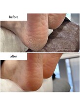 ケアプラス(care plus)/足裏角質ケア