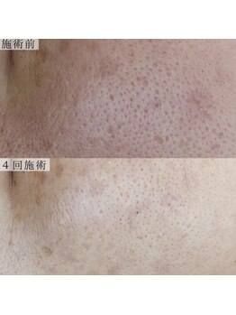 ヴェルシック(Belchic)/でこぼこ肌から滑らか肌へ