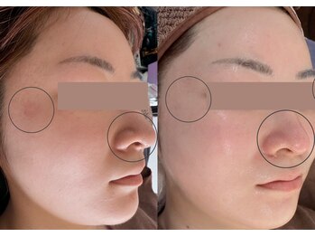 アイビ(愛美)/光フェイシャル