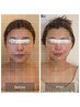 【お顔の筋膜の癒着を解消して美しいお顔へ】美顔調整＋サーマルリフト