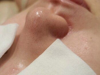 ピナリ(PINARI)の写真/韓国で話題の【ESV10】で肌質改善◎セルフケアではなかなか改善しないお悩みもおまかせください
