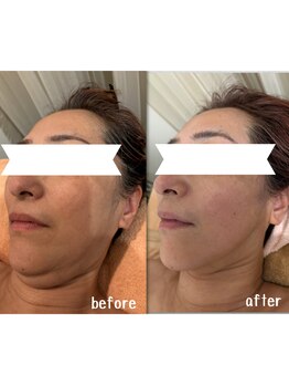 ラディアント(Radiant)/インディバ/レモンボトル