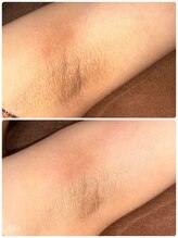 シャナ(Shana)/カーボキシーボディ(脇)