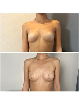 モア(moa)/バストメイク/ボディメイク