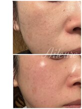 エルール トータルビューティ(Aileure total beauty)/VOSフェイシャル