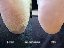 冬のゴワゴワ踵も角質ケアでふわふわベビーフットに！