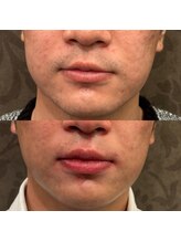 フェリーバ(FELIVA)/脱毛は根気のいる作業！