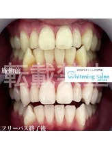 ホワイトニングサロン 福岡天神店/ホワイトニング