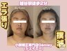 【エラ張り食いしばりに特化！】エラ張りでお悩みの方はコチラ(所要時間90分)