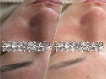 マヴィ 香里園店(MavY.)/本気の肌質改善