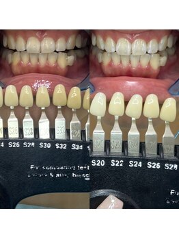 トウキョウスワーズ 池袋店(TOKYO SWRS)/#ホワイトニング #池袋 #渋谷