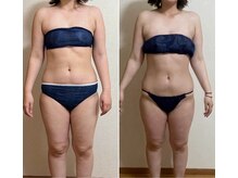 リュミエール(umiere)/ラジオ波の脂肪燃焼がすごい！