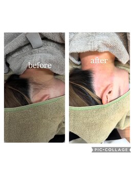 ルナ 植木店(Luna)/うなじwax+光脱毛