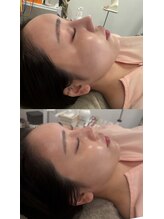 マホロバ(mahoroba)/美容鍼+ララピール