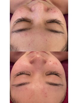 ビューティーサロン アンジェリーク/REVI before→after