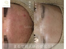 サロンドレナ 名駅店/ハーブピーリング サロンドレナ