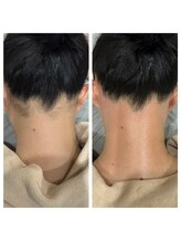 エピリア(Epilear)/うなじワックス