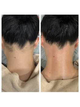 エピリア(Epilear)/うなじワックス