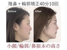 ラプリボヤージュ 藤沢店(Raplit)/隆鼻＋輪郭矯正40分