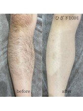 シャレールオム(Chareir Homme)/ひざ下脱毛10回ビフォーアフター