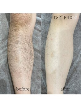 シャレールオム(Chareir Homme)/ひざ下脱毛10回ビフォーアフター