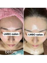 ルーチェエムベルシック(Luce.MBelChic)/水光肌ピーリング