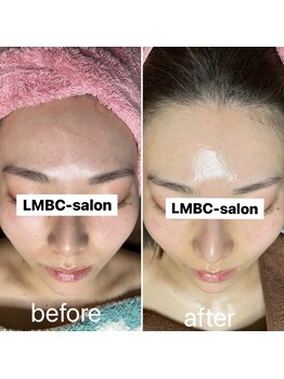 ルーチェエムベルシック(Luce.MBelChic)/水光肌ピーリング