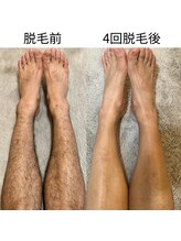 アルテ(ARTE)/脚脱毛ビフォーアフター