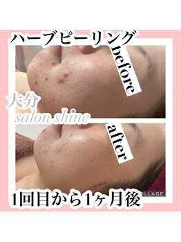 サロンシャイン(Salon Shine)/ハーブピーリング2回