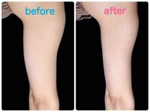 エルミューノ(elμno)/上腕部 ビフォーアフター