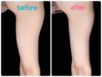 エルミューノ(elμno)/上腕部 ビフォーアフター