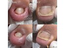 【巻き爪/陥入爪】
