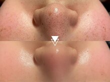 1回の施術でも効果実感