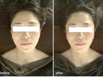 アベリア リュウ(Aberia Lieu)/頭蓋小顔矯正/小顔矯正