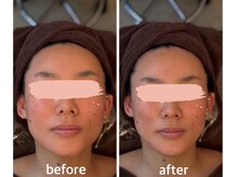 ドクター ヴィーナス/ラジオ小顔エステ　1回