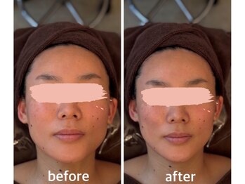 ドクター ヴィーナス/ラジオ小顔エステ　1回