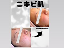 ワン(One)の雰囲気（ニキビ肌でお悩みの方のハーブピーリング8回後のお肌です。）