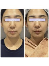 アリウム(Allium)/痩身機械で小顔へ