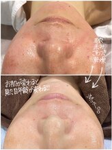 OBS新潟整骨院/お肌の赤みでお悩みの方！