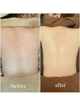 ベレミアム(Bellemium)/REVIで背中の肌荒れ・ニキビケア